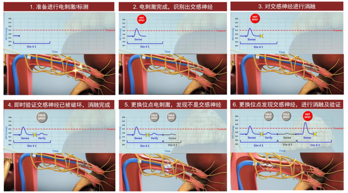 资料来源：Pythagoras Medical官网，中金公司研究部