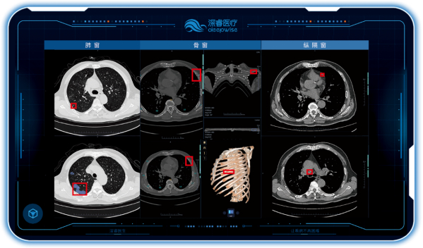 　　▲Dr.Wise®胸部CT AI医学辅助诊断系统