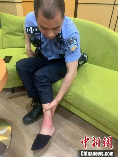 葛恒脚踝被燃烧木炭烫伤。　宿迁警方供图