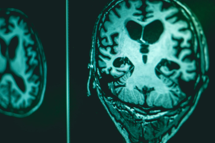 ↑阿尔茨海默症患者还有可能出现激动、混乱甚至暴力狂躁等症状。资料图。