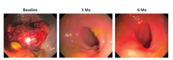 其中一名患者的内窥镜检查结果显示肿瘤渐渐消失 图片来源：《新英格兰医学杂志》