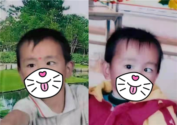 　　图为小王小时候斜视照片