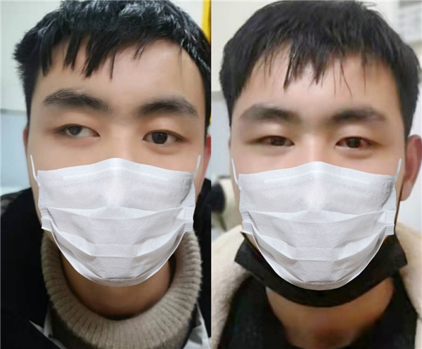 　　图为小王术后照片