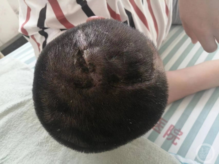 ▲赵大勇被撞后做了开颅手术。图片来源/受访者供图