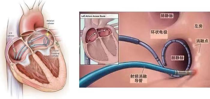 聚焦|一纸收购公告背后的心脏电生理江湖之争_手机新浪网