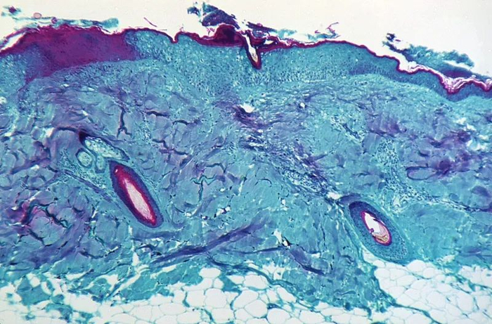 △在放大50倍的情况下，显示了从一只感染了猴痘病毒的猴子皮肤病变处获取的皮肤组织切片。