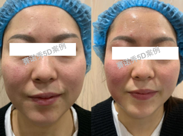 　　赛诺秀5D胶原光左右脸不对称调节前后对比图