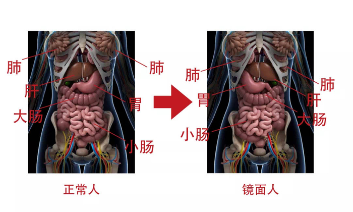 “镜面人”的五脏六腑是“反转”的。图片来源：广西医科大学附属武鸣医院