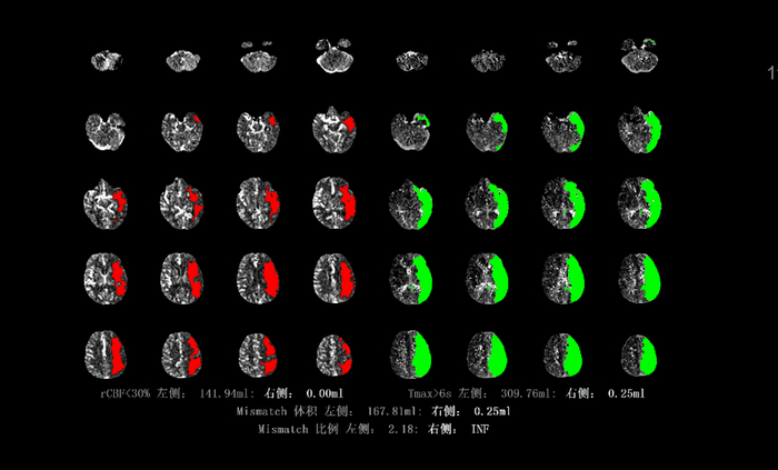 　　NBC软件的CT及MR灌注图像