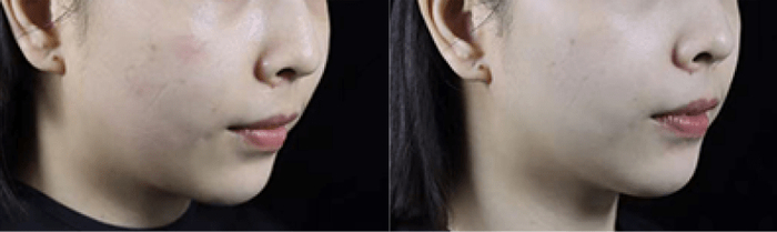 　　赛诺秀5D胶原光治疗1次前后对比图