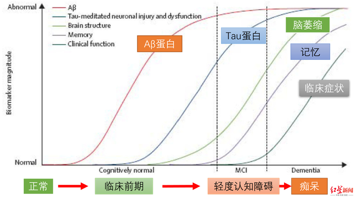 ↑阿尔茨海默症的病情发展阶段