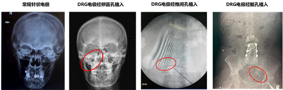 　　瑞神安SCS注册临床试验