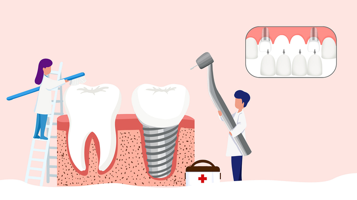 牙体种植 图片来源：摄图网