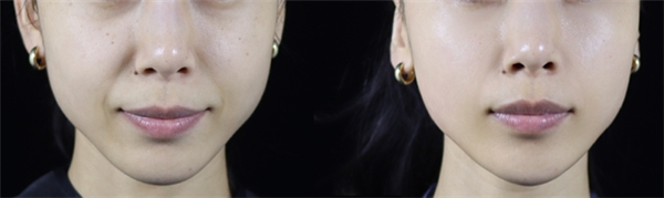 　　【赛诺秀5D胶原光治疗1次前后对比图】