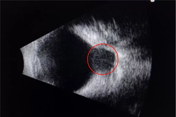 　　图上标注红色圈位置就是巩膜后葡萄肿