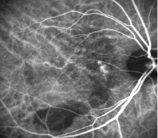 　　Spectralis HRA高对比度造影图像
