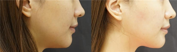 　　【赛诺秀5D胶原光治疗1次对比图】