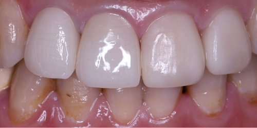 　　烤瓷牙修复领域的应用