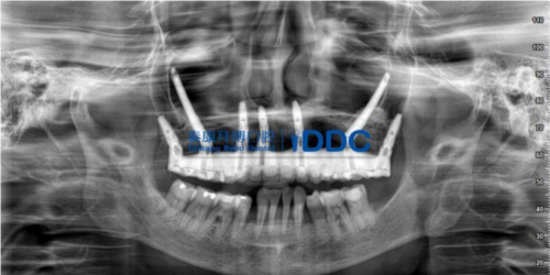 　　穿颧手术修复全景片