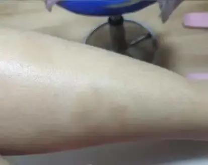 持续治疗一年后达到完全清除（PASI 100）