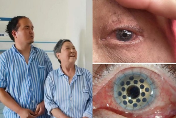 　　领扣型人工角膜患者术后图1