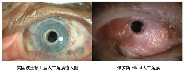 　　美国波士顿Ⅰ型人工角膜植入图;俄罗斯 Micof人工角膜