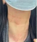 这是一个原有控制良好的慢性荨麻疹患者，阳性发热后出现全身皮疹猛然加重，演变为急性荨麻疹。