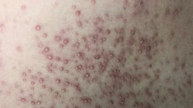 图片来源：《皮肤性病诊断图鉴》（张建明、李海英主编）