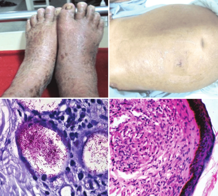 麻风病患者的临床和显微镜图像。患者腿部结节性红斑伴有腹水 图源：Research Gate