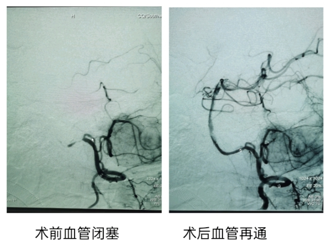 术前术后血管对比图。西南医院供图