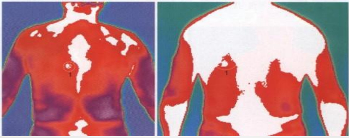 △胃穴背面图：胃体体表投影区，提示胃的较严重病变可能。