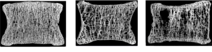 骨质正常到轻度骨质疏松、严重骨质疏松