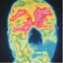 △右侧周围型面瘫，瘫痪侧略偏高温