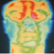 △通过红外热成像判断，为正常头面部