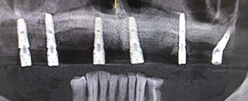 　　6颗种植体恢复上半口14颗牙齿