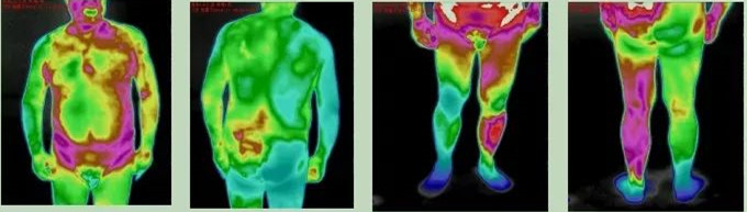 △中风后遗症：颈部压痛，右肩外展受限，右侧下肢运动受限。神经损伤，引起远端肢体的功能下降，患侧的热代谢明显低于对侧。