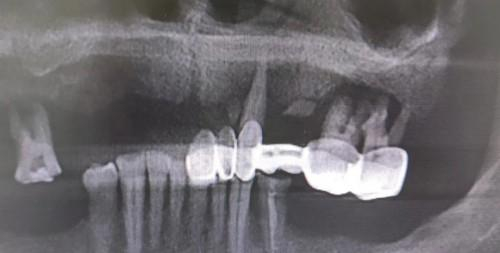 　　上半颌仅剩3颗残牙，咀嚼功能几乎没有