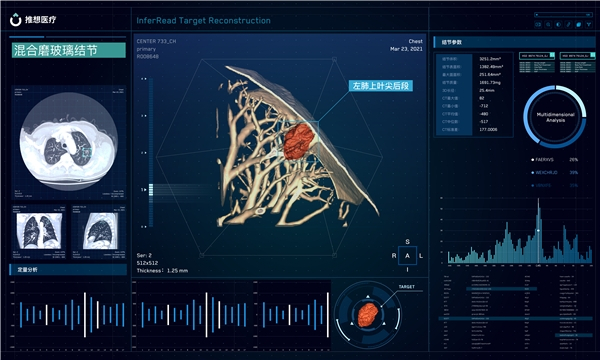 　　推想肺结节AI靶重建产品概念图