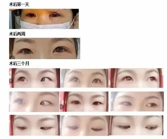 　　图：吴女士术后眼睛照片