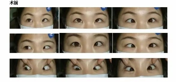 　　图：吴女士术前眼睛照片