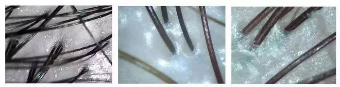 ▲用了一段时间的征服青蒿洗发乳后，毛囊健康，长出来的头发也更强韧不易掉