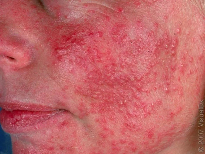 皮损图片 6，图片来源：见水印