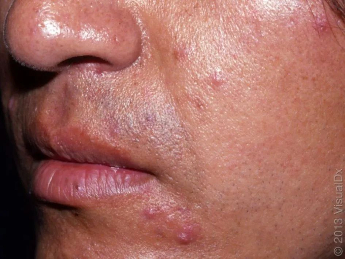 皮损图片 1，图片来源：见水印