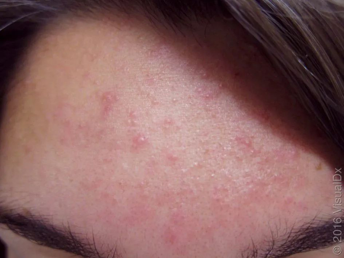 皮损图片 3，图片来源：见水印