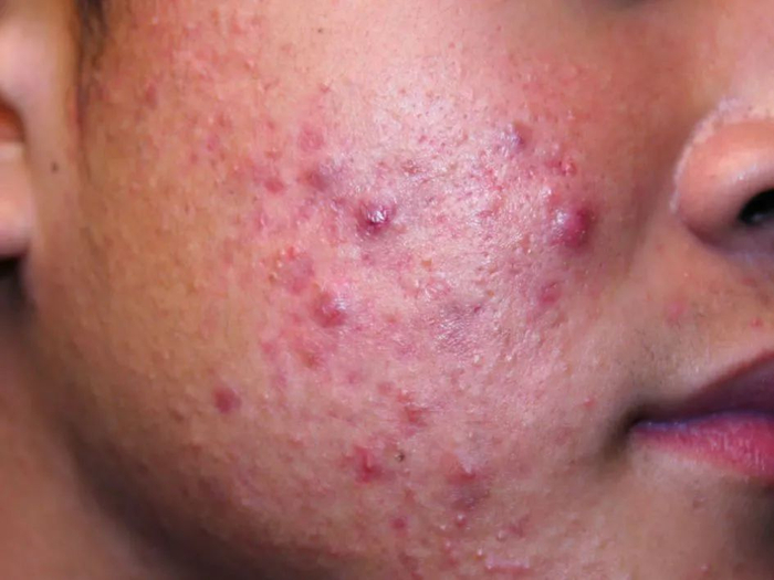 图 2. 炎症性痤疮——常始于粉刺，进而扩大形成丘疹、脓疱、结节和囊肿等不同严重程度的皮损，图片来源：见水印