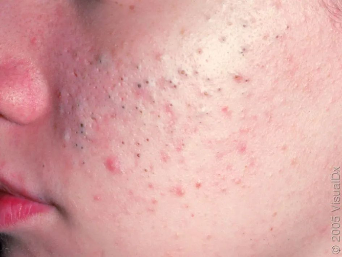 图 1. 非炎症性痤疮——特征为开放性和闭合性粉刺（黑头和闭口），图片来源：见水印