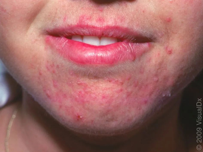 皮损图片 4，图片来源：见水印