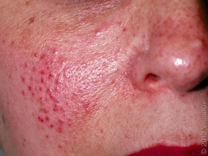 皮损图片 2，图片来源：见水印