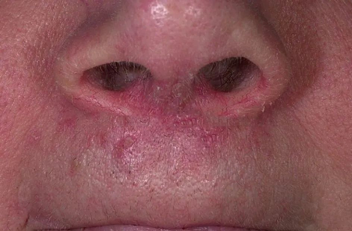 皮损图片 3，图片来源：见水印