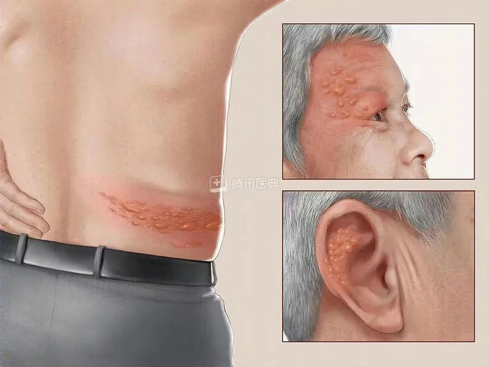 带状疱疹，图源：腾讯医典